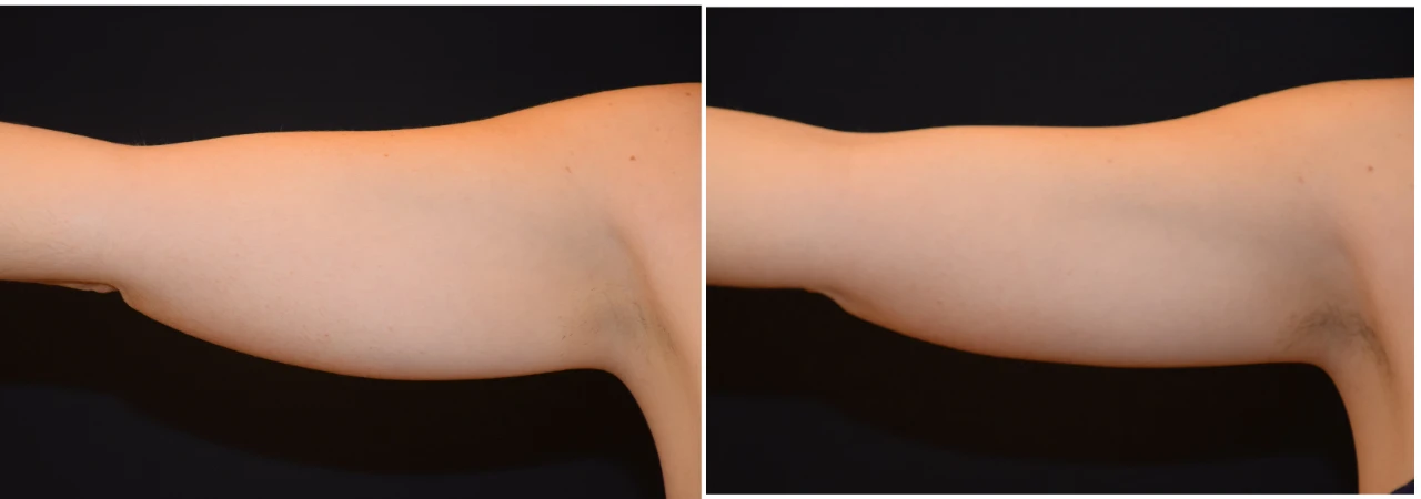 coolsculpting-brazos-1-sesion-mujer