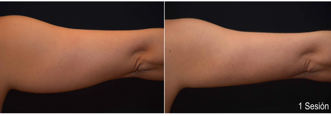 coolsculpting-brazos-1-sesion