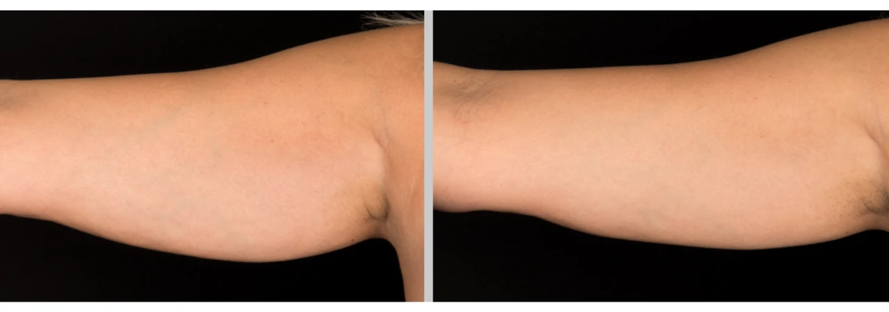 coolsculpting-brazos-1-sesionon-mujer