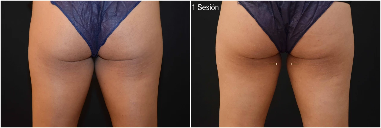 coolsculpting-muslos-01