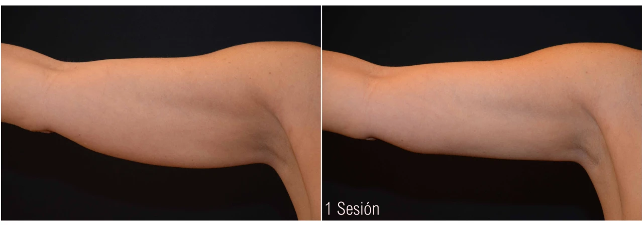 criolipolisis-brazos-1-sesion